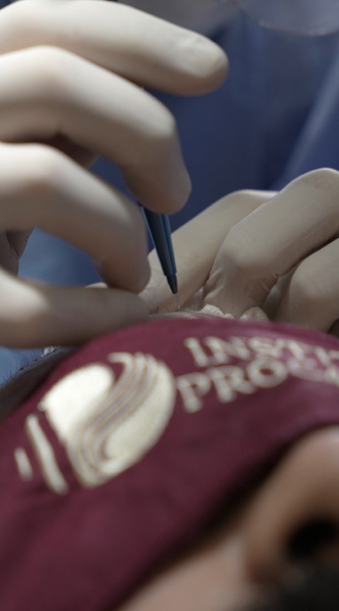 Transplante de barba