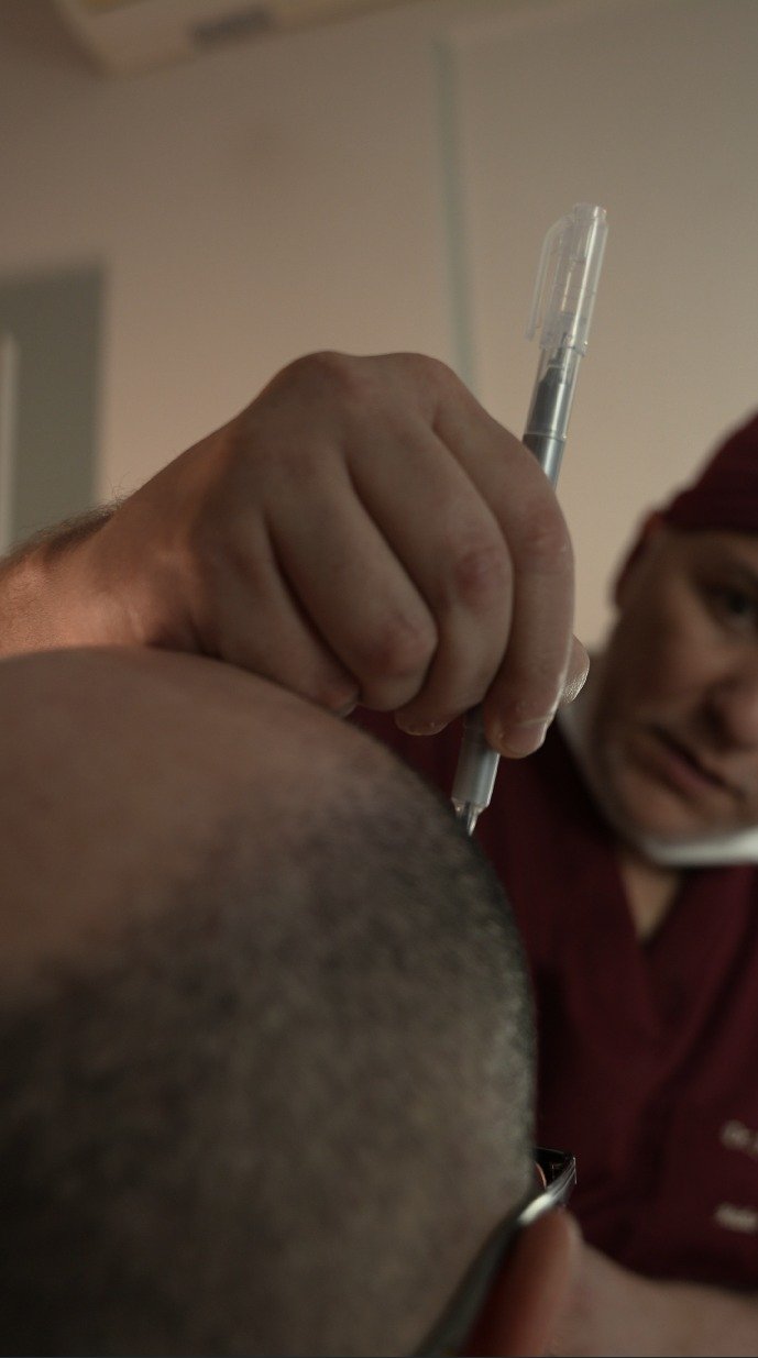 Procedimento de transplante capilar