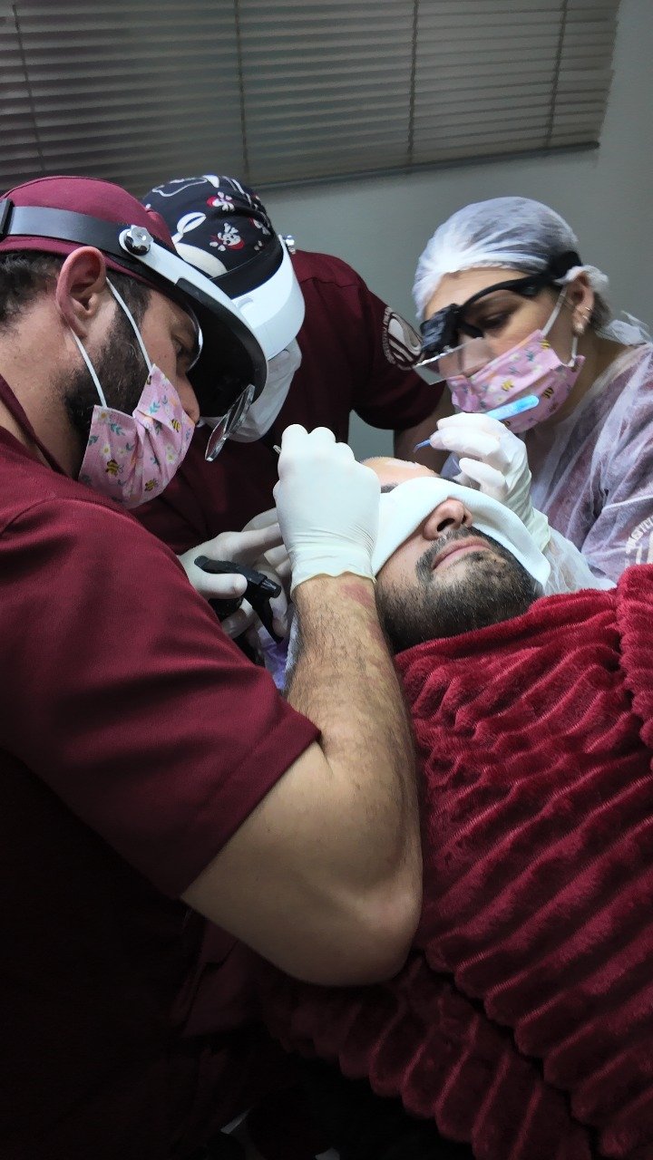 Resultado de transplante capilar